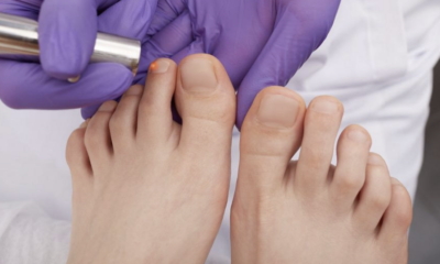 Laser Treatments Toenail Fungus