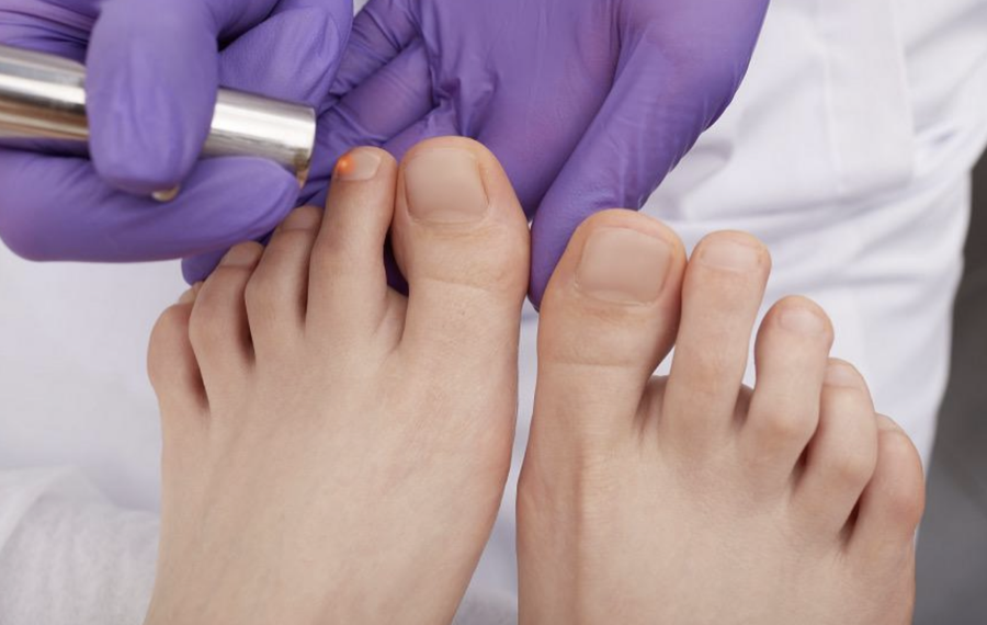 Laser Treatments Toenail Fungus