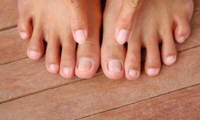 natural solutions for fungal toenails