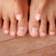 natural solutions for fungal toenails